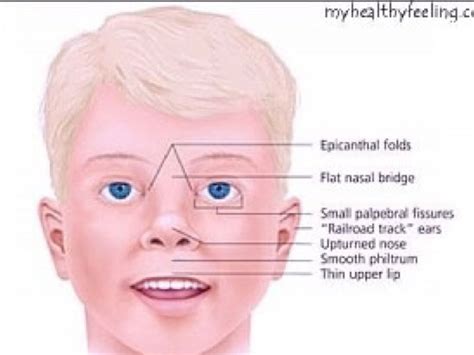 prader willi syndrome pictures.